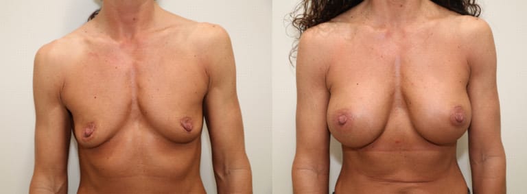 Breast augmentation transformation – comparison of natural breasts before surgery and fuller, lifted appearance after surgery