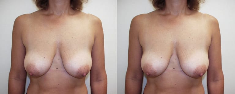 Before and after breast lift surgery – front comparison showing improved breast position and contour at Cary Plastic Surgery