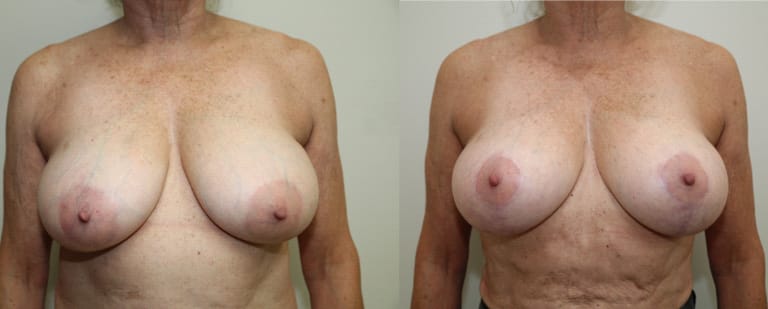 Pre-operative vs post-operative breast lift result – uplifted breast shape and firmer profile from mastopexy procedure