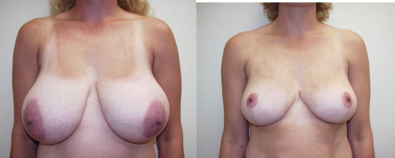 Before and after breast reduction surgery – frontal comparison showing reduced breast size and improved contour at Cary Plastic Surgery