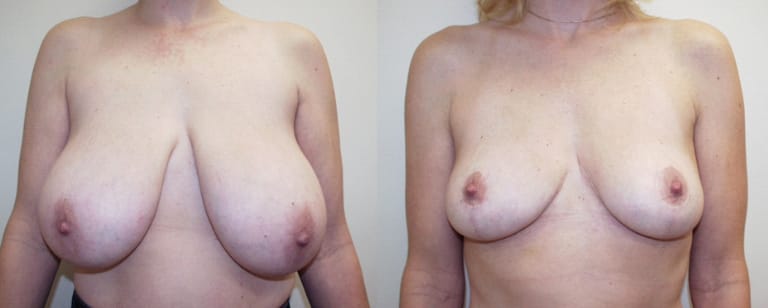 Pre-operative vs post-operative breast reduction result – smaller, proportionate breasts with balanced silhouette and anatomical refinement