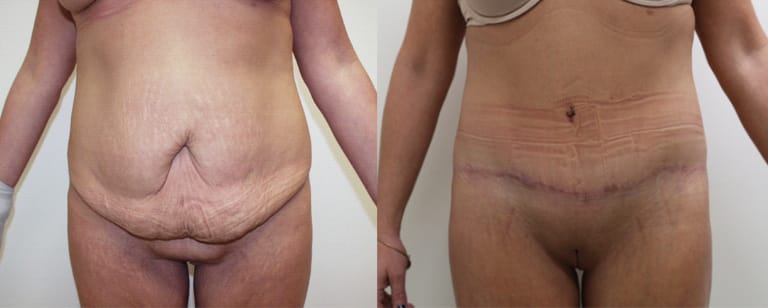 Before and after tummy tuck (abdominoplasty) – frontal comparison showing flatter, more toned abdomen and improved contour at Cary Plastic Surgery