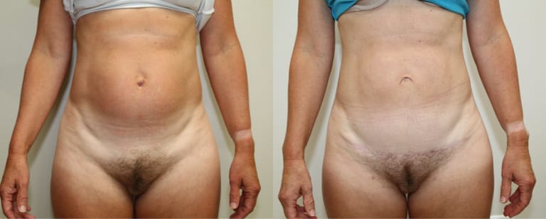 Abdominoplasty before and after – transformation showing smoother waistline and firmer midsection at Cary Plastic Surgery