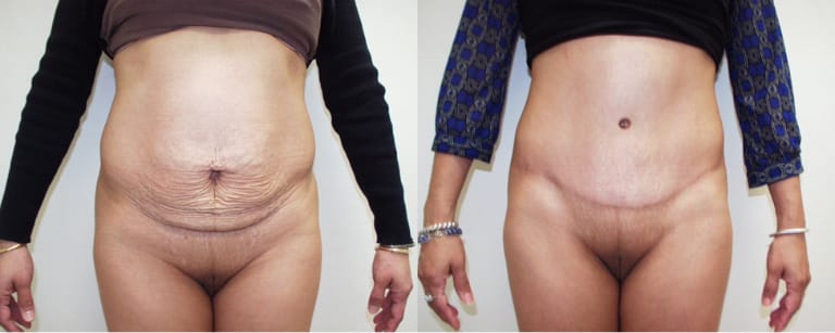 Tummy tuck before and after – enhanced abdominal shape with removal of excess skin and improved muscle tone