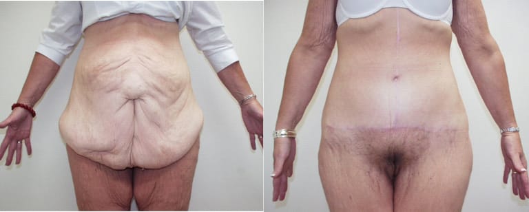 Pre-surgery vs post-surgery tummy tuck outcome – visibly flatter stomach and refined body contour after abdominoplasty