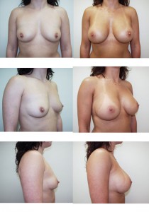 Breast augmentation in Cary, NC