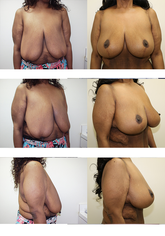 Breast lift – plastic surgery in North Carolina