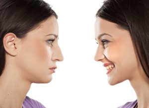Woman before and after cosmetic surgery